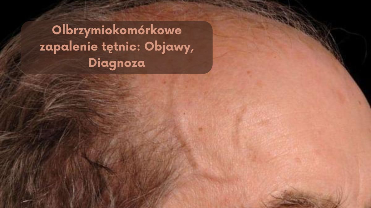 Olbrzymiokomórkowe zapalenie tętnic: Objawy, Diagnoza