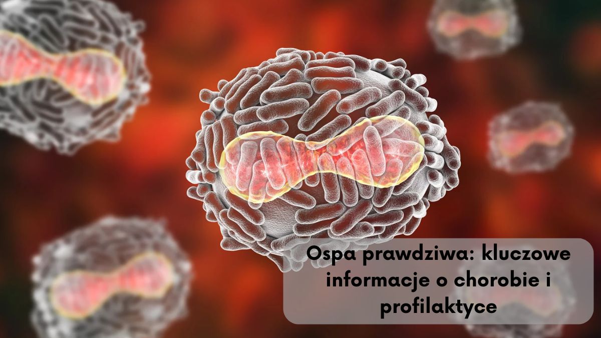 Ospa prawdziwa: kluczowe informacje o chorobie i profilaktyce