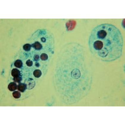 Entamoeba histolytica