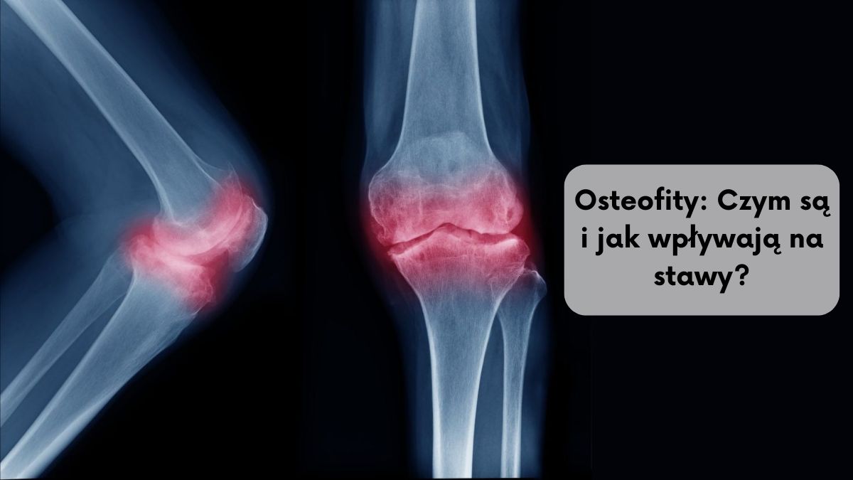 Osteofity: Czym są i jak wpływają na stawy?