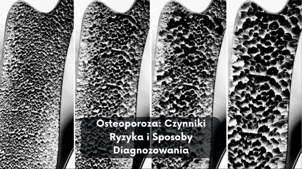 Osteoporoza: Czynniki Ryzyka i Sposoby Diagnozowania