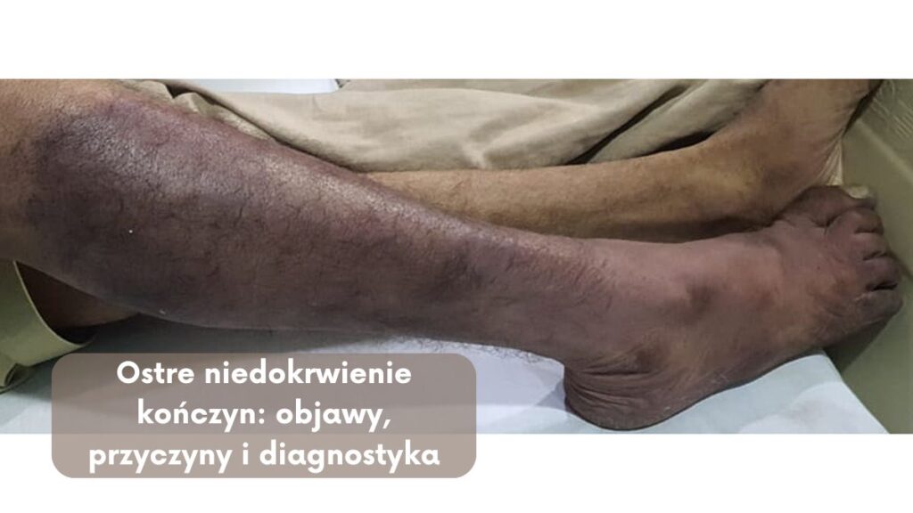 Ostre niedokrwienie kończyn: objawy, przyczyny i diagnostyka