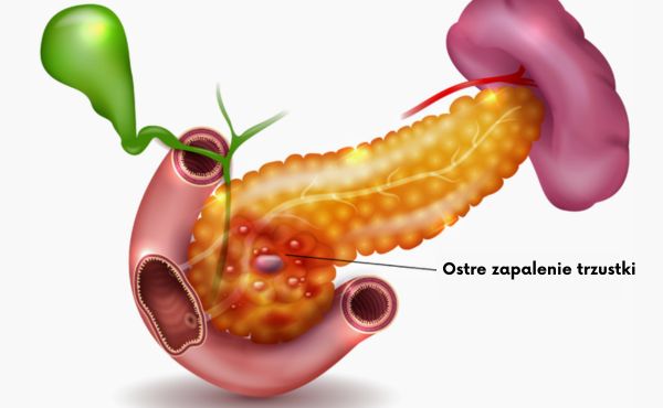 Ostre zapalenie trzustki