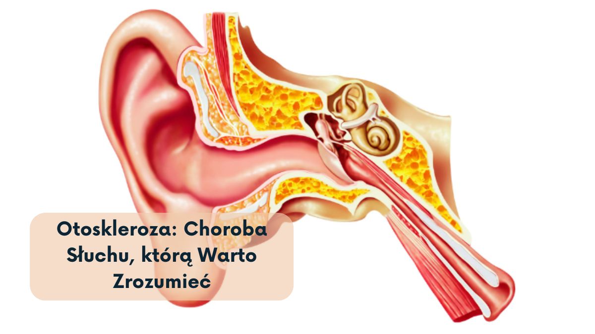 Otoskleroza: Choroba Słuchu, którą Warto Zrozumieć