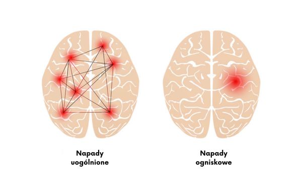 Napady ogniskowe a Napady uogólnione