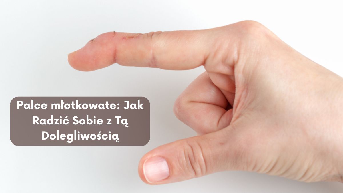 Palce młotkowate: Jak Radzić Sobie z Tą Dolegliwością