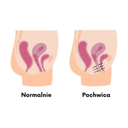 Pochwica