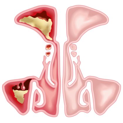 Przewlekłe zapalenie błony śluzowej nosa i zatok
