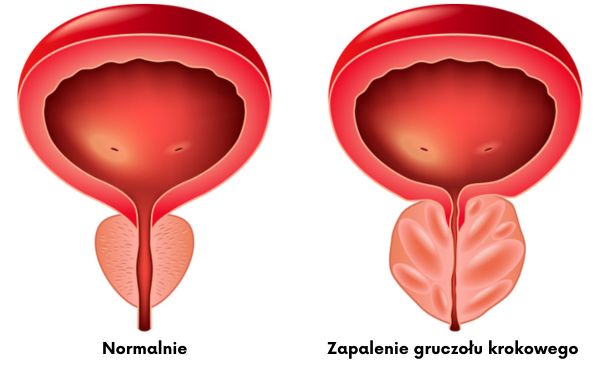 Zapalenie gruczołu krokowego