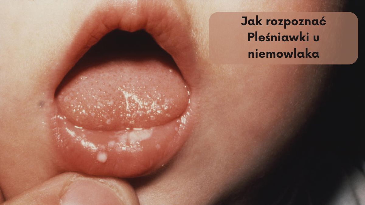 Jak rozpoznać Pleśniawki u niemowlaka