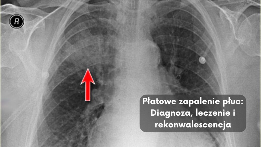 Płatowe zapalenie płuc: Diagnoza, leczenie i rekonwalescencja