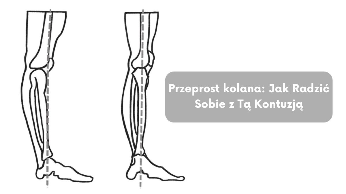 Przeprost kolana: Jak Radzić Sobie z Tą Kontuzją