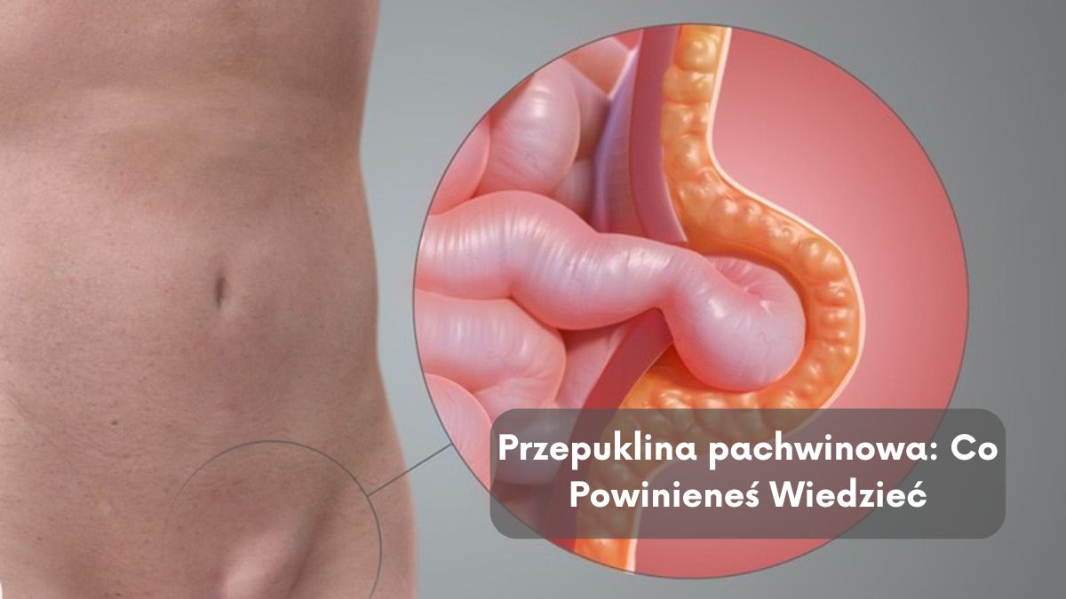 Przepuklina pachwinowa: Co Powinieneś Wiedzieć