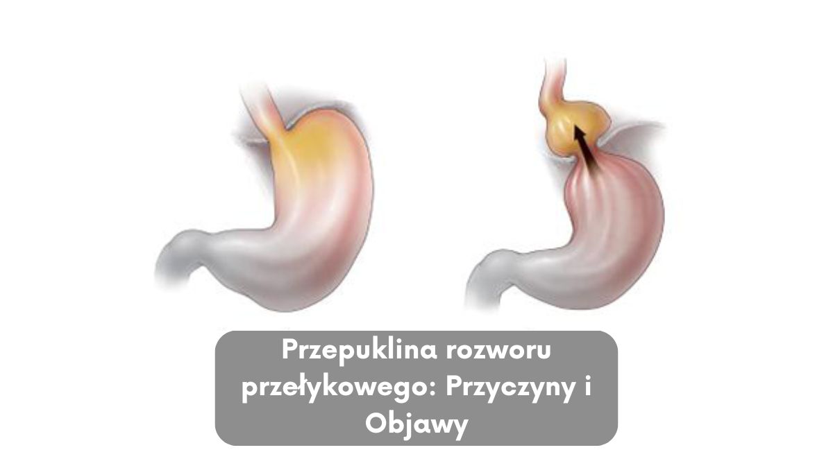 Przepuklina rozworu przełykowego: Przyczyny i Objawy