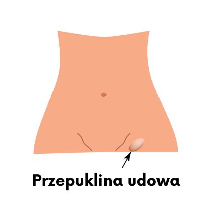 Przepuklina udowa