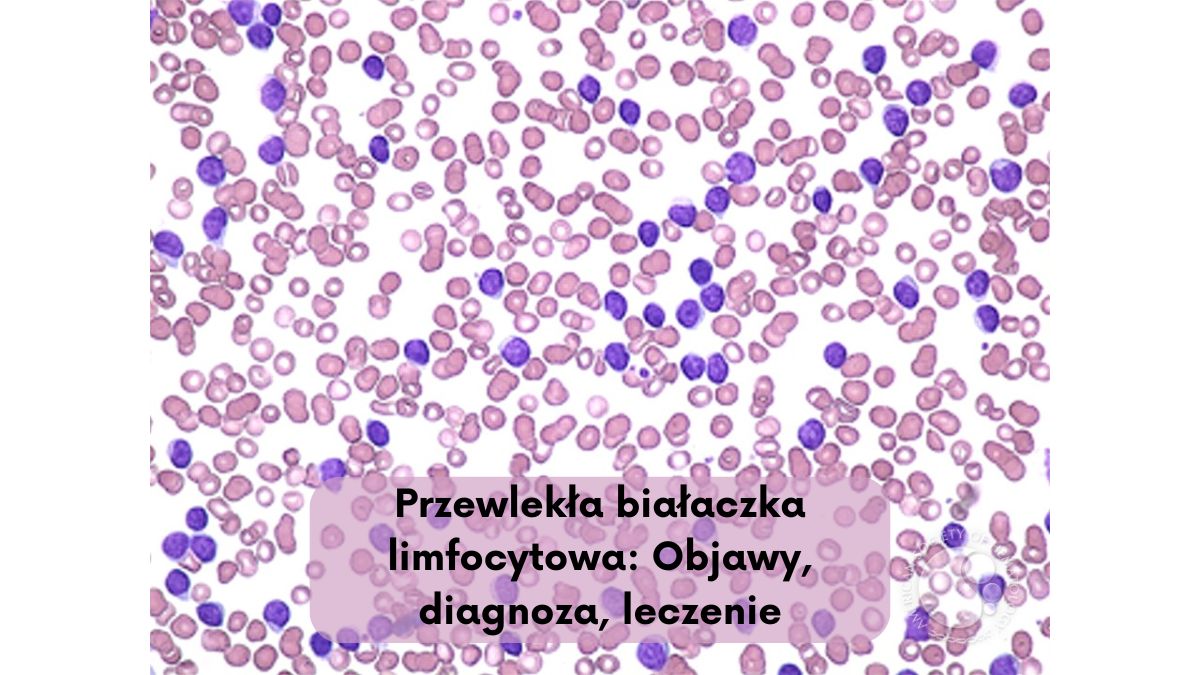 Przewlekła białaczka limfocytowa: Objawy, diagnoza, leczenie