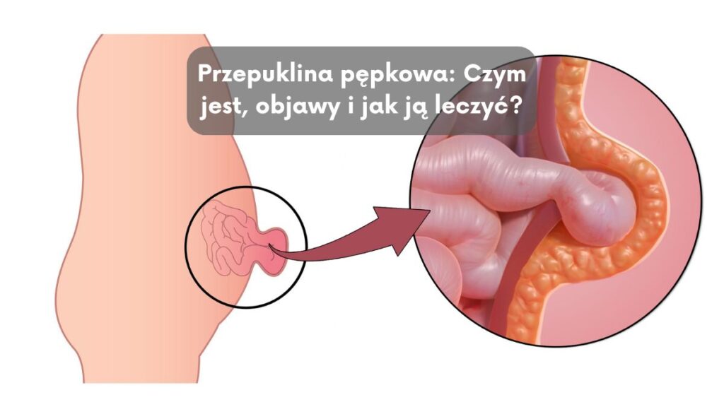 Przepuklina pępkowa: Czym jest, objawy i jak ją leczyć?